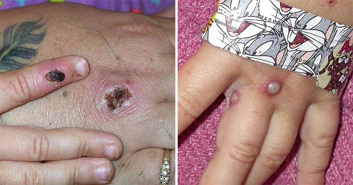 Tuyên truyền phòng, chống dịch bệnh Đậu mùa khỉ